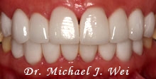 after porcelain veneers