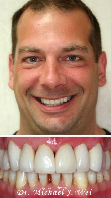 daniel after porcelain veneers