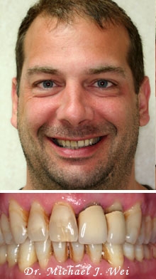 daniel before porcelain veneers