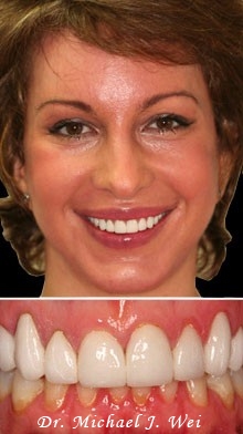 marcella2 after porcelain crowns