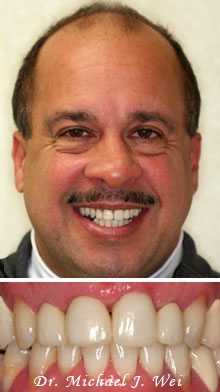 ralph after porcelain crowns and veneers