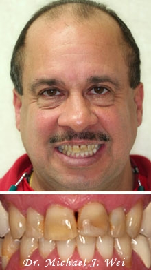 ralph before porcelain crowns and veneers