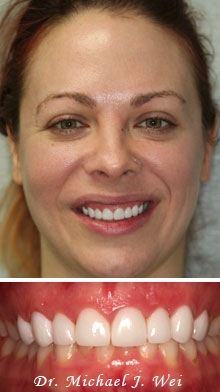 erica r after porcelain veneers