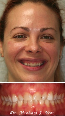 erica r before porcelain veneers