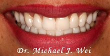 angela v after porcelain veneers