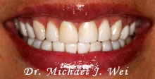 angela v before porcelain veneers