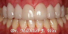 case 22 after porcelain veneers, tooth colored fillings