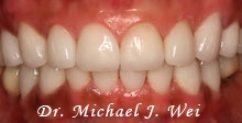 after porcelain veneers - michelle c