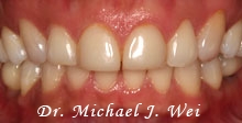 before porcelain veneers michelle c