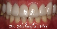 miwa l after porcelain veneers, tooth crowns, tooth-colored fillings