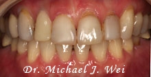 miwa l before porcelain veneers, tooth crowns, tooth-colored fillings