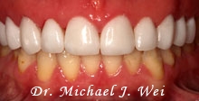 kathleen m after porcelain veneers