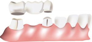 dental bridges