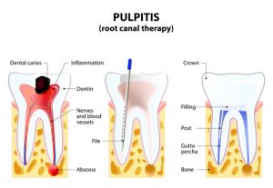 Root Canal Manhattan Dentist