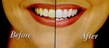 whitening