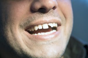 cosmetic dentistry for chipped tooth